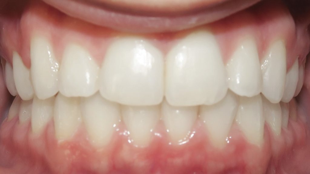 Invisalign Results - AngelinaBurcevskiAfter 1