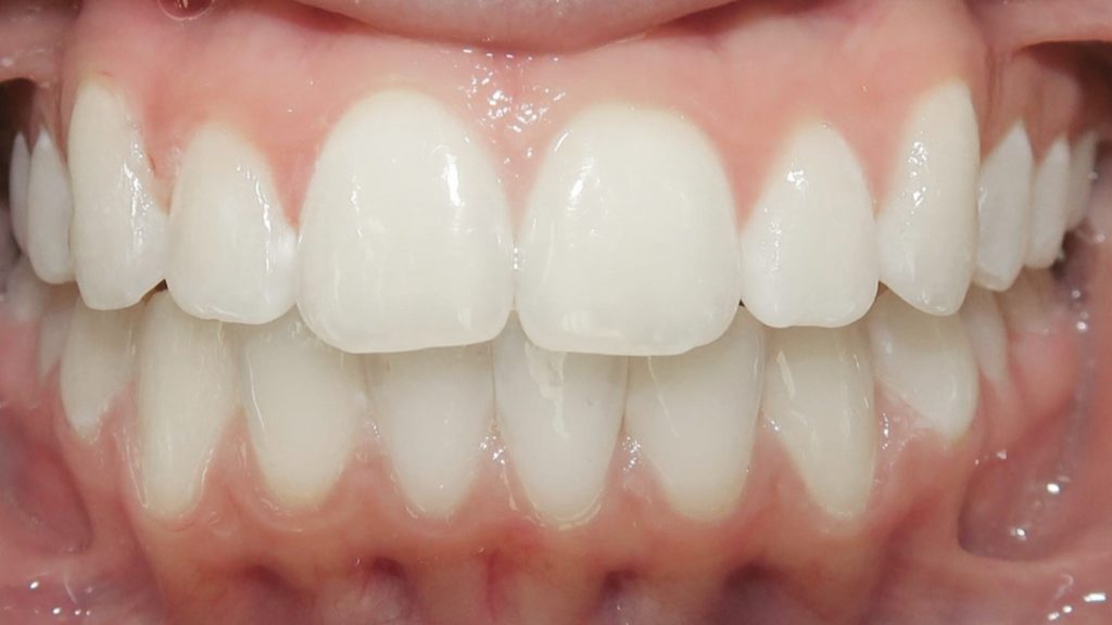 Invisalign Results - BronwynBothAfter 1