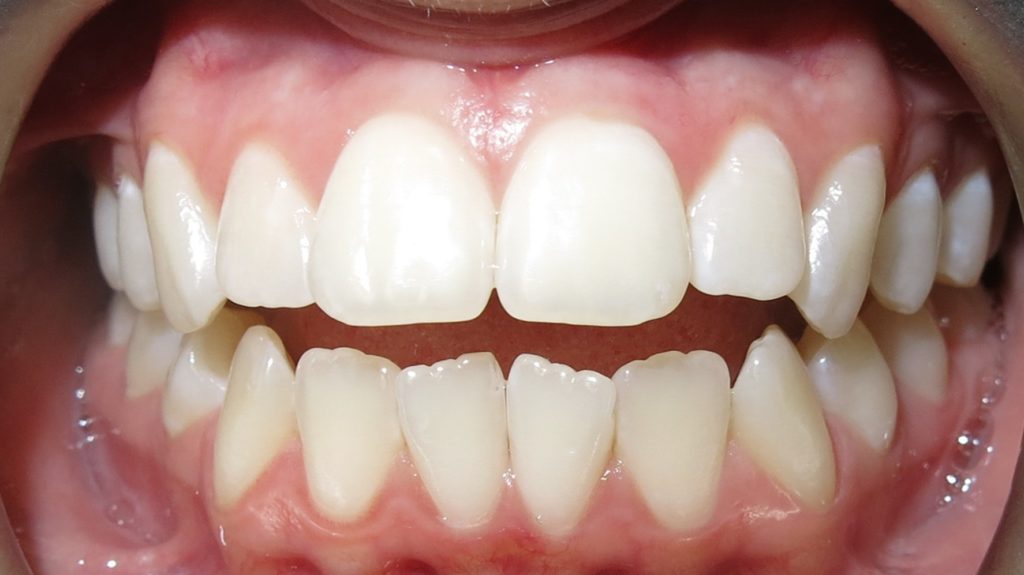 Invisalign Results - BronwynBothBefore 1