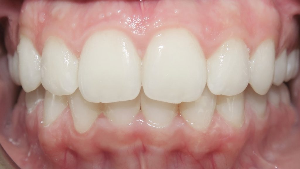 Invisalign Results - CeannaKoesterAfter 1