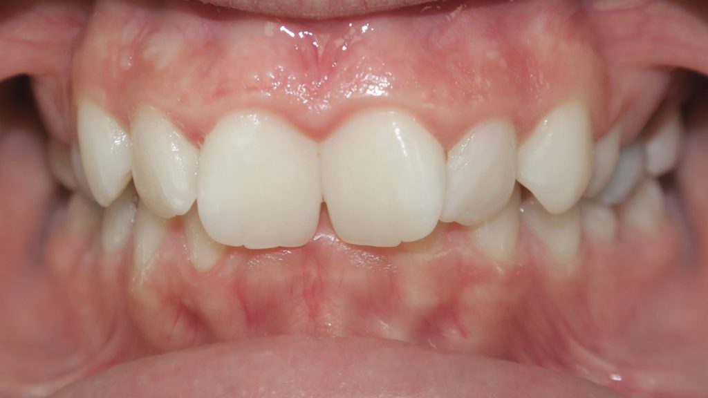 Invisalign Results - CeannaKoesterBefore 1