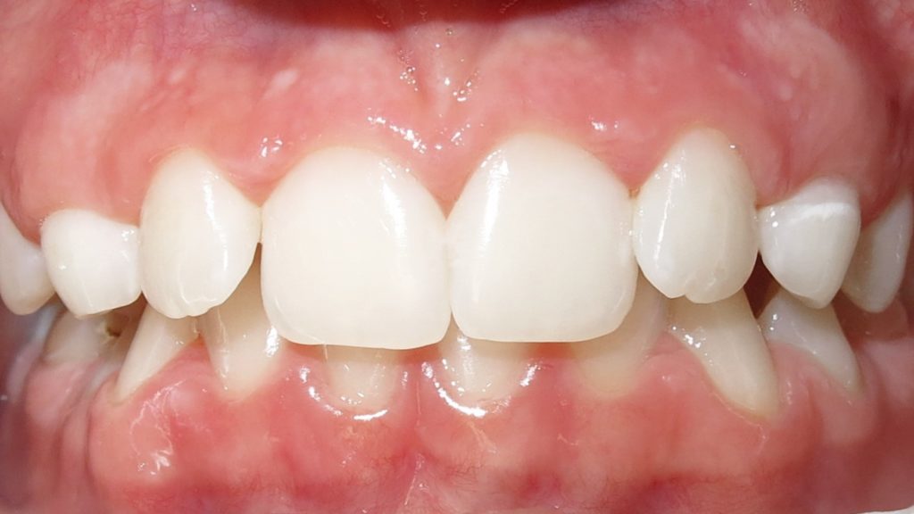 Invisalign Results - EmmaHefronBefore 1