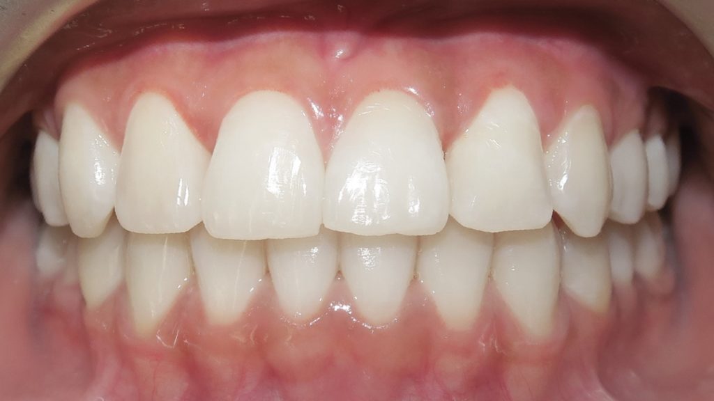 Invisalign Results - GraceJimenaAfter 1