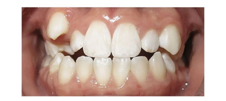 Impacted Canine Teeth Calgary - Jarad e1748974652607 Jarad teeth