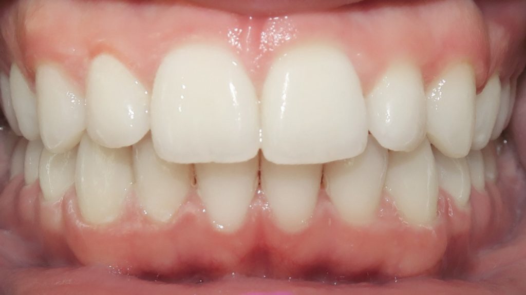 Invisalign Results - JordanCameronAfterCenter 1