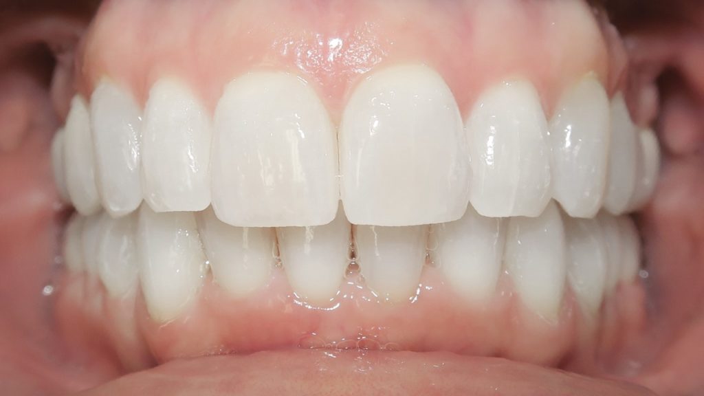 Invisalign Results - RonaYeagerAfter 1