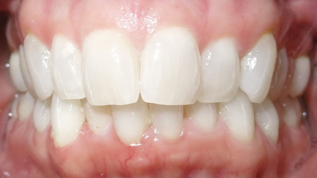 Invisalign Results - RonaYeagerBefore 1