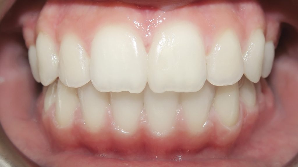 Invisalign Results - SelenaLtaifPh2After 1