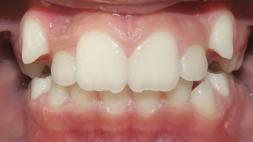 Invisalign Results - SelenaLtaifPh2Before 1