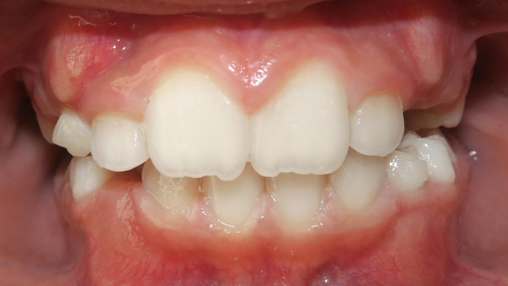 Invisalign Results - SelenaLtaifPhIAfter 1