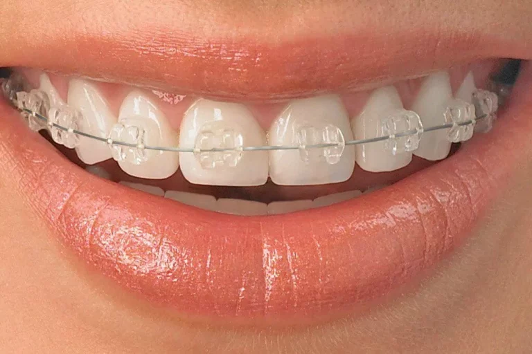 Clear Braces in Calgary, Invisalign Dentist