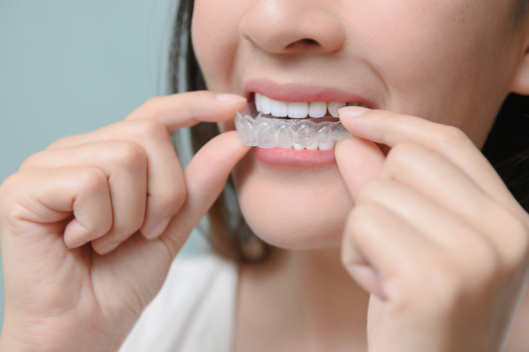 Invisalign Results - shutterstock 1476376424