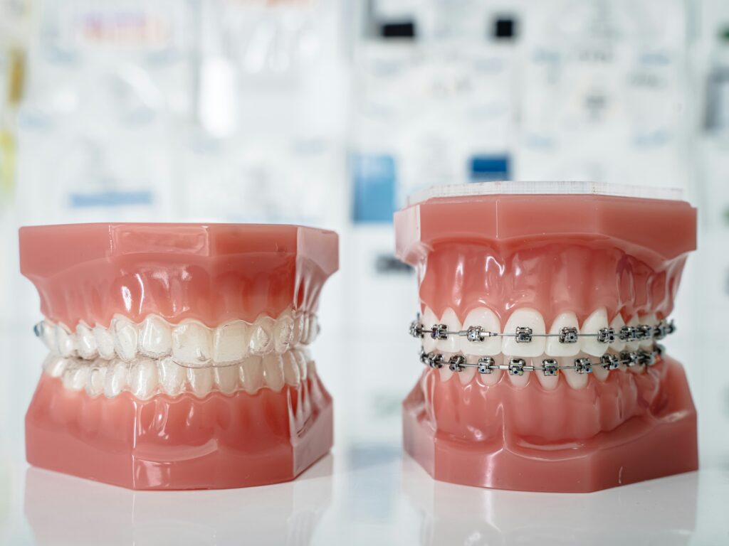 Top Tips for Preparing for Braces: What to Expect and How to Make it Easy - katarzyna zygnerska B9lLokDYTMY unsplash Top Tips for Preparing for Braces: What to Expect and How to Make it Easy - katarzyna zygnerska B9lLokDYTMY unsplash