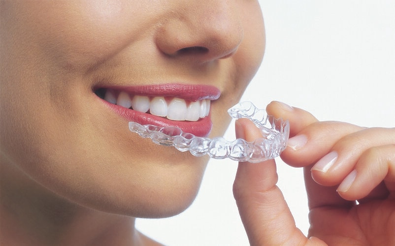How Long Does Invisalign Take? - invisalign